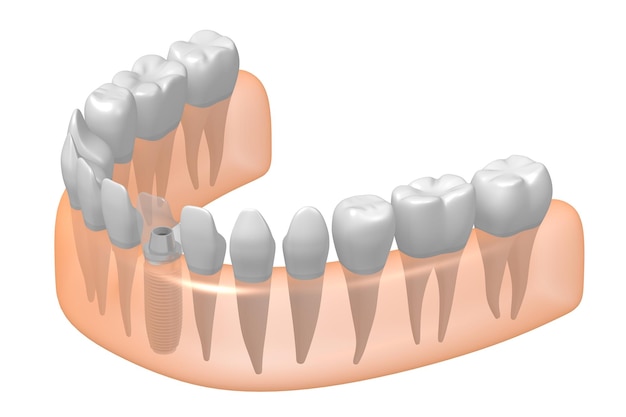 写真 歯のインプラントその他の健康なものと歯肉の 3 d イラストレーション