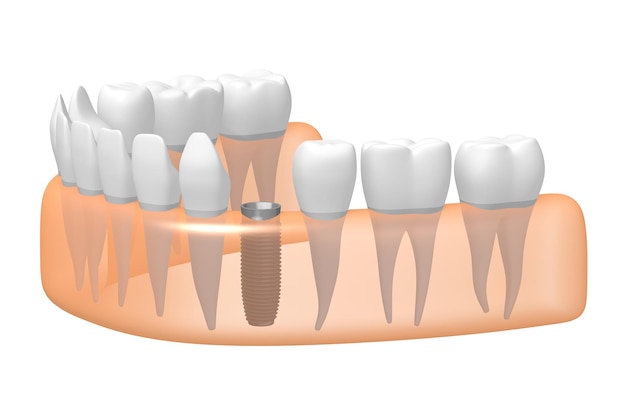 写真 歯のインプラント他の健康な歯と歯肉の 3 d イラストレーション
