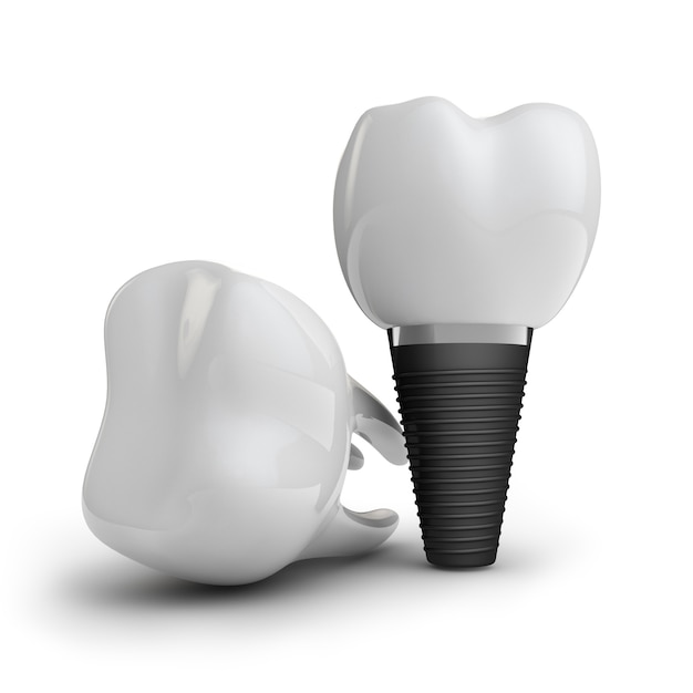 Photo tooth implant