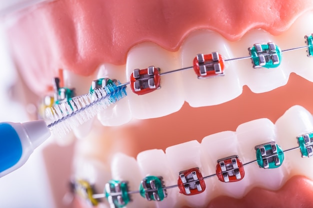 Modello del dente da apparecchi ortodontici con spazzolino per la pulizia dei denti interdentali.