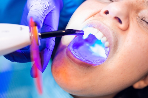 Ultraviolet Light Cure Fillings