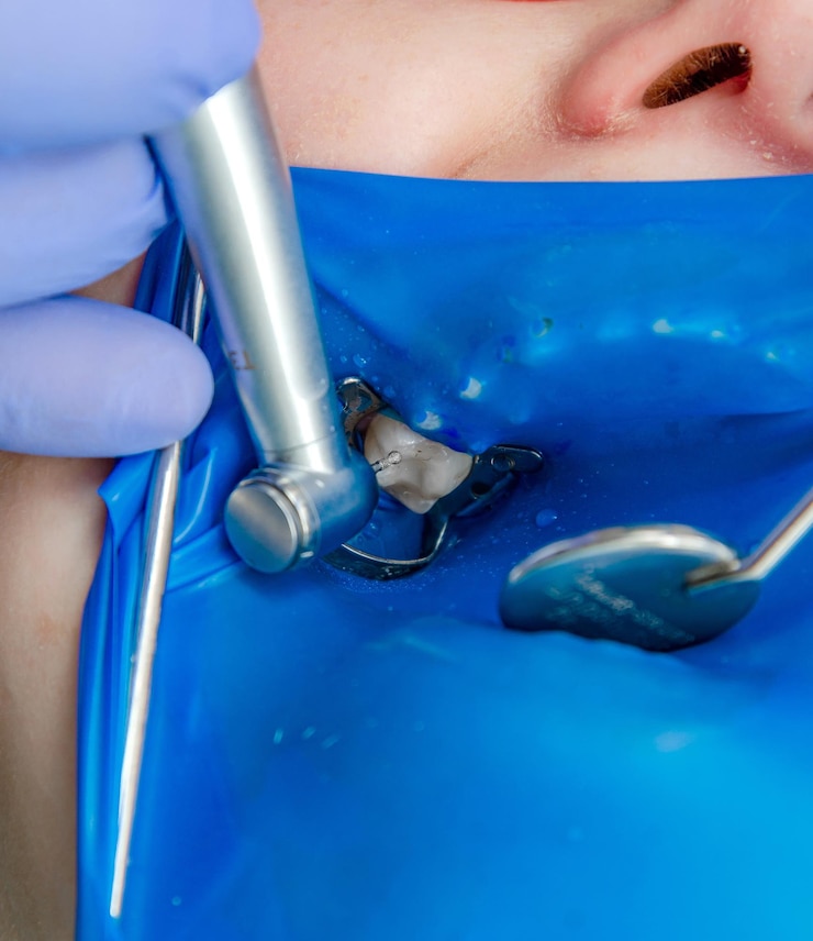 Photo tooth treatment in dentistry the mouth is covered with a blue rubber pad