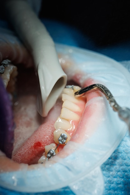 Foto vista dall'alto del processo di spazzolamento dei denti del paziente pulizia dei denti con getto d'acqua e aspirasaliva divaricatore per guancia sulle labbra il concetto di igiene orale professionale bretelle sui denti