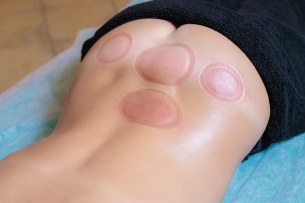 Photo traces after the hijama procedure on the body of a young girl