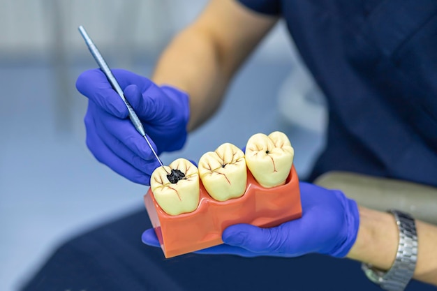 Photo training, education, practicing dentist work. demonstration different stages caries on model. mock of diseases teeth in dental clinic