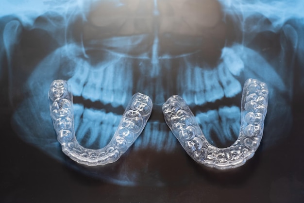 Transparent bite correction trays and xray of the jaw Orthodontist equipment