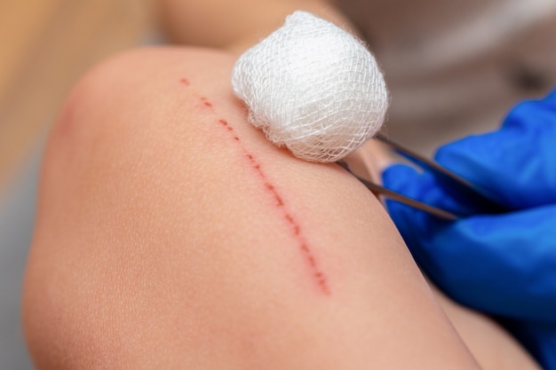 Treating scratches wound on a kid hand