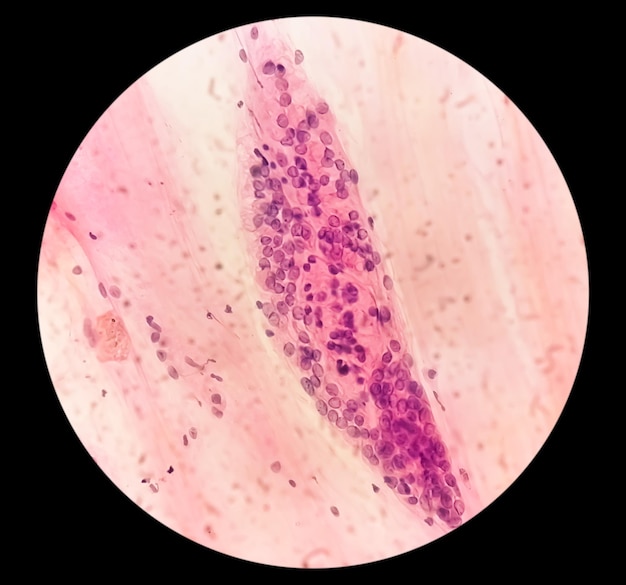 Trichomonas vaginalis in pap smear with few acute inflammatory cells. Trichomoniasis. STD