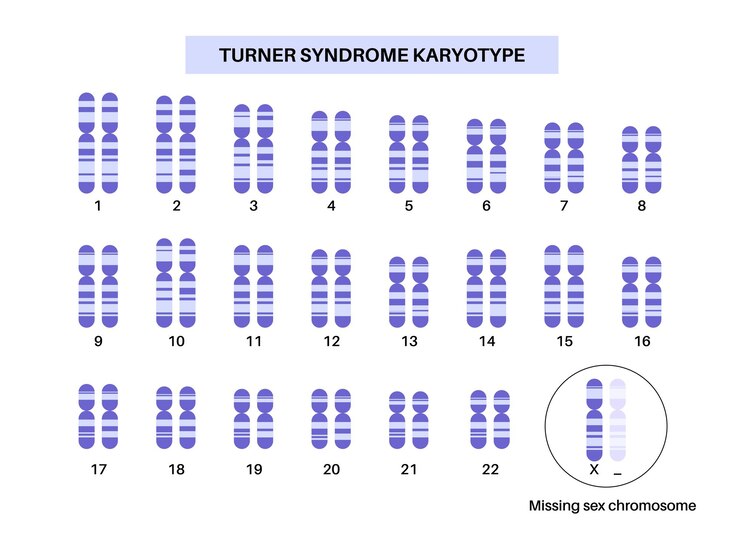 Foto turner syndroom poster