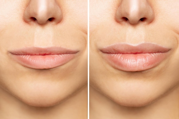 Two shots of young womans lips before and after lip enhancement Lip augmentation