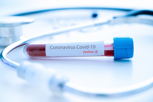 Uitbraak van Coronavirus Covid-19. Geneeskunde en epidemie concept. Dokter dient medische buis in voor het vasthouden van handschoenen met positief bloedtestresultaat voor het snel verspreiden van Coronavirus 2019-nCoV in laboratorium