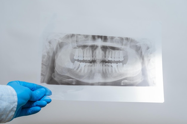 Uitzicht op radiografie van de kaak Tandröntgenfoto van de mondholte van de patiënt met tanden