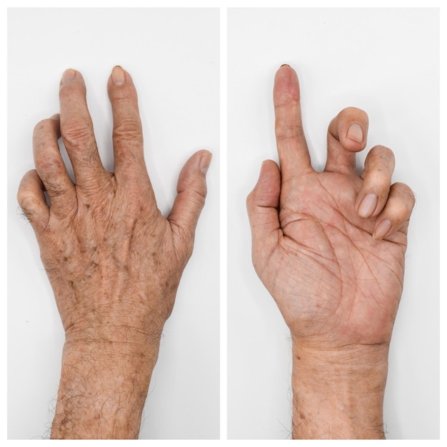 Photo ulnar claw hand of asian elder man also known as 'spinster's claw