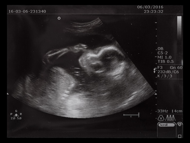 Photo ultrasonography picture