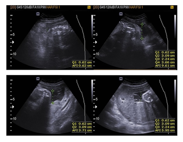 Ultrasound  abdomen.