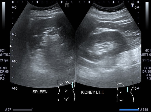 Foto l'imaging medico dell'addome ad ultrasuoni dell'addome mostrava milza e rene sinistro.