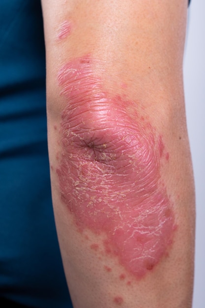 Unrecognizable man feel bad on skin disease called psoriasis\
large red inflamed rash on elbows