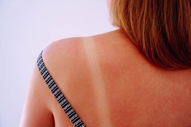 Unrecognizable person shows an unburned strip on back from straps of swimsuit Healthy skin Sun protection products