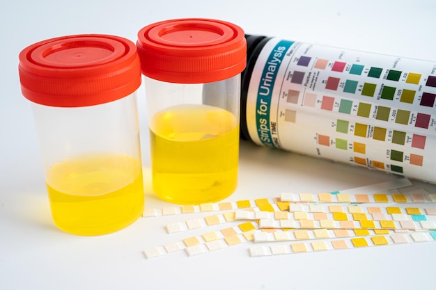 Photo urinalysis urine cup with reagent strip ph paper test and comparison chart in laboratory