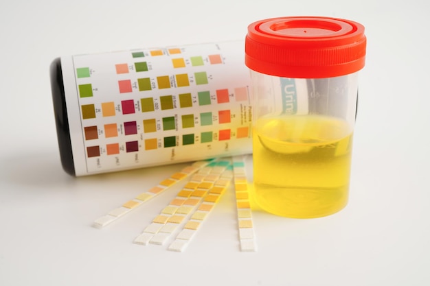 Urinalysis urine cup with reagent strip pH paper test and comparison chart in laboratory