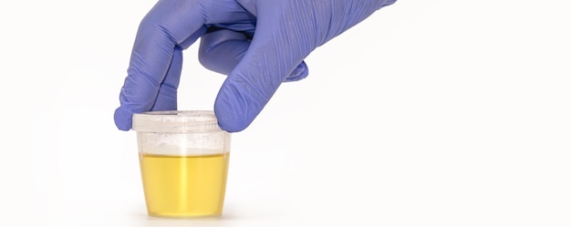 Foto flacone per la raccolta delle urine tenuto da una mano guantata blu test delle urine eas urina per testo e controllo medico isolato sfondo bianco copyspace