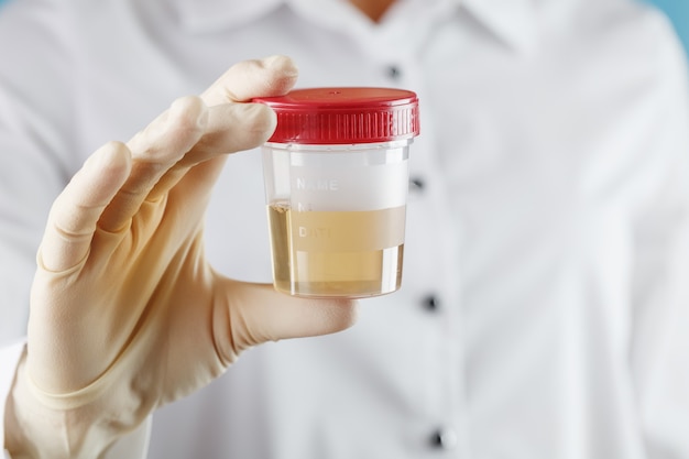 Urine tests in a plastic medical container