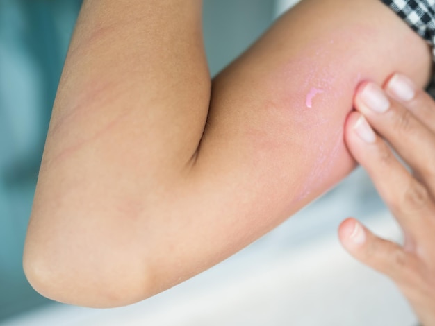 Urticaria bij de hand vrouw niet-dodelijk type door voedsel- en luchtvergiftiging ze past calamine lotion-medicijn toe op de arm hershe ziek hebben een allergische reactie urticaria op huid bodyhealthcare concept