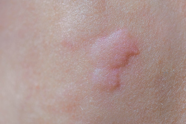 Photo urticaria on the skin red spots of an allergic reaction on the skin of a child urticaria symptoms cl