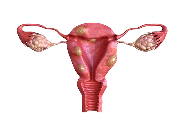 Foto i fibromi uterini sono tumori solidi benigni formati da tessuto muscolare