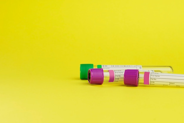 収集用の真空管と黄色の背景の血液サンプル。紫と緑のふたで透明。データを識別するためのラベル。セレクティブフォーカス。