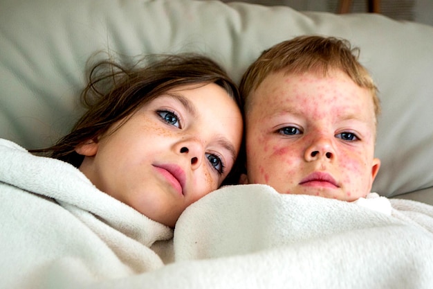 Varicella virus or Chickenpox bubble rash on child