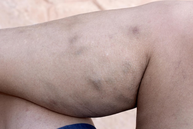 Photo varicose veins deep vein thrombosis venous injuries on legs