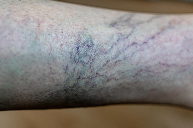 Foto vene varicose sulle gambe trattamento vascolare