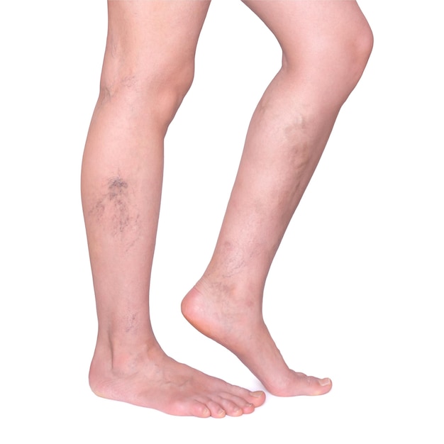 Varicose veins in the legs Woman legs isolated on white