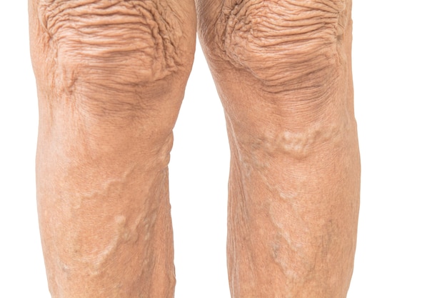 Varicose veins in old women