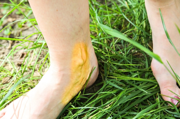 Photo varicosity on the woman's leg. medical treatment of health problem. big blue vein. barefoot on the grass.