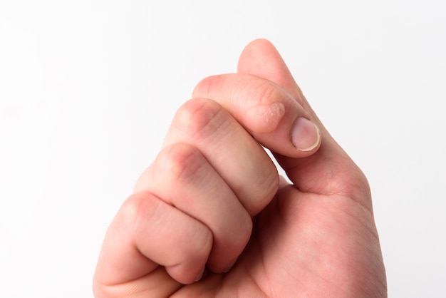 Verbrand aan de vinger van een vrouw