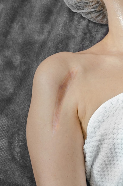 Vertical keloid scar after bone surgery on a woman's shoulder