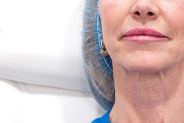 Immagine verticale delle labbra che prendono iniezioni di acido ialuronico e botox in una clinica estetica