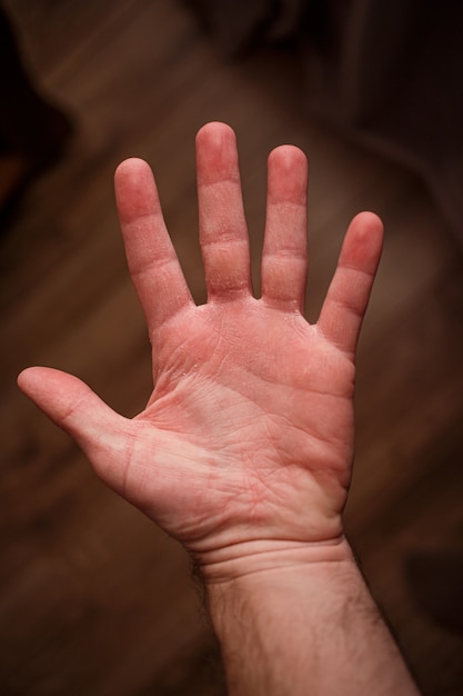 アルコール洗浄による非常に乾燥した手の皮