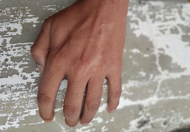 Very neat stitch marks on the hand