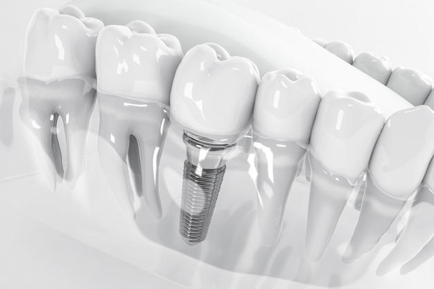 View from above of a false tooth implant fixed in the jawbone; 3d; 3d illustration