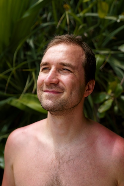 Photo view of man with sunburn skin at the beach