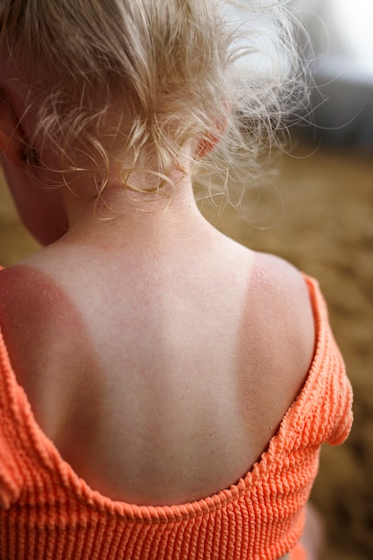 Photo view of young girl with sunburn skin at the beach