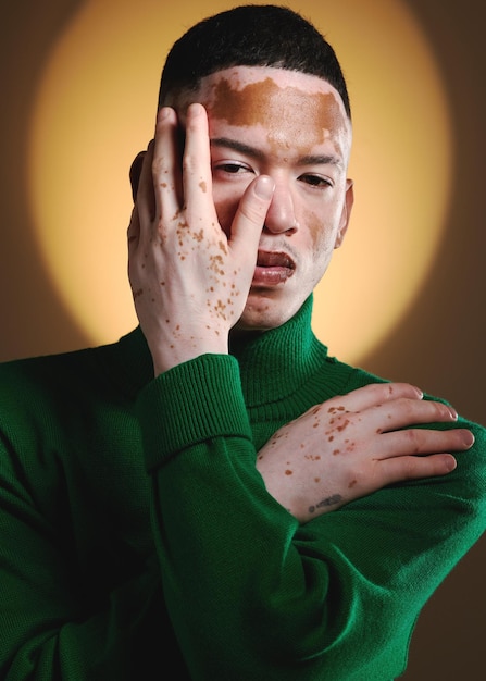 럭셔리 뷰티 스타일과 디자이너 브랜드 스킨 색소침착 손 포즈를 위한 Vitiligo 남자 얼굴과 패션 모델 초상화, 창의적이고 세련된 빛으로 값비싼 옷을 위해 포즈를 취하는 모델