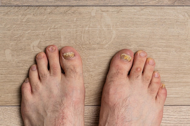 Foto voeten van een man close-up van vingers aangetast door een schimmelnagelplaat lelijke tenen