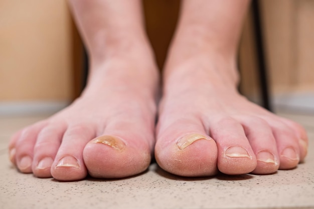 Voeten van persoon besmet met schimmel op witte tegelvloer