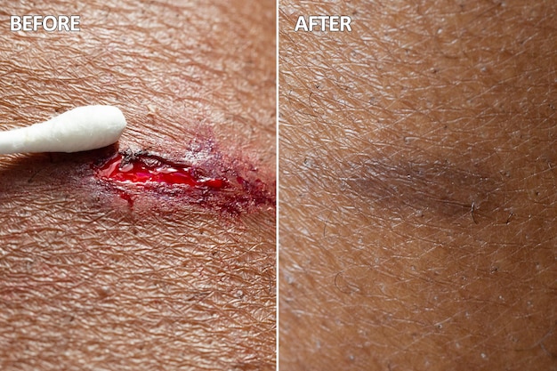 Voor en na een genezingsbehandeling op een wond op de huid