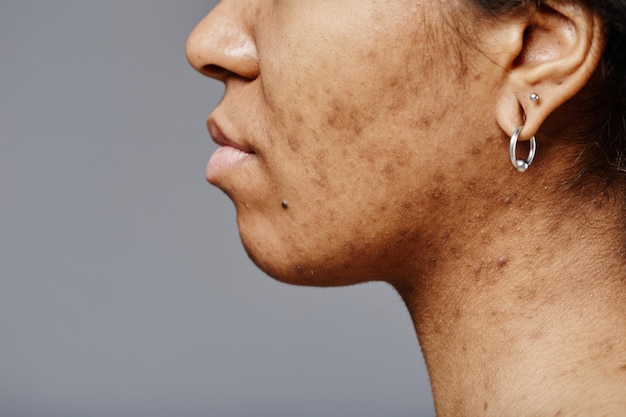 Vrouw met acnelittekens op gezicht