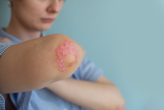 Vrouw met psoriasis Psoriasis vulgaris Gewrichten aangetast door artritis psoriatica